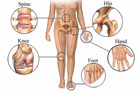 Exercise, Weight Loss and Arthritis